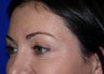 crows feet