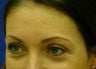 crows feet
