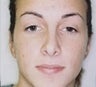 Female patient who underwent ear surgery