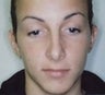 Female patient who underwent ear surgery