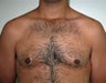 Adolescent Male treated for Breast Reduction