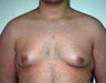 Adolescent Male treated for Breast Reduction