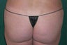 Buttock Augmentation With Fat Transfer