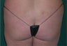 Buttock Augmentation With Fat Transfer