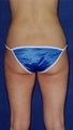 liposuction body