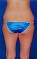 liposuction body