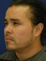 Subcision on a 37 Year Old Hispanic Male for Rolling Acne Scars