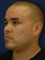 Subcision on a 37 Year Old Hispanic Male for Rolling Acne Scars