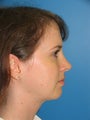 33 yr old with liposuction of the neck