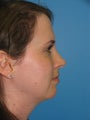 33 yr old with liposuction of the neck