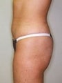 Female patient who underwent a butt lift