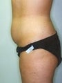 Female patient who underwent a butt lift