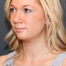 Chin Augmentation
