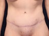 40 Year Old Woman After Gastric Bypass