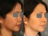 Asian rhinoplasty with rib cartilage harvest, diced cartilage fascia (DCF) dorsal augmentation.