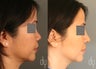 Asian rhinoplasty with rib cartilage harvest, diced cartilage fascia (DCF) dorsal augmentation.
