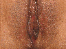 Vaginoplasty