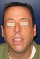 Chin Implant