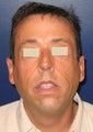 Chin Implant