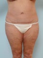 Body Lift