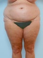 Body Lift