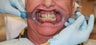 All-on-4 Dental Implants
