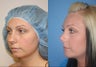 Rhinoplasty