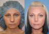 Rhinoplasty