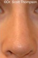 Revision Rhinoplasty Surgery