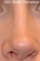 Revision Rhinoplasty Surgery