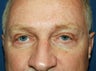 lower eyelid surgery