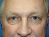 lower eyelid surgery