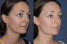 Before & After Fraxel Dual Treatment