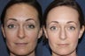 Before & After Fraxel Dual Treatment