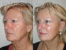 Endoscopic Browlift and Endoscopic Mid Facelift