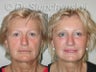 Endoscopic Browlift and Endoscopic Mid Facelift