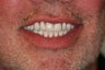 55 year old male treated with All-on-4 Dental Implant Procedure