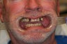 55 year old male treated with All-on-4 Dental Implant Procedure