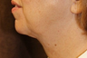 Ultherapy Neck