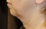 Ultherapy Neck
