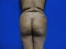 26 Year Old, Brazilian Butt Lift, Butt Augmentation with Fat Grafting