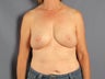 Breast reconstruction / augmentation with fat transfer after implant removal
