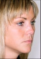 Rhinoplasty
