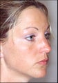 Rhinoplasty