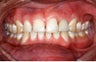 Female Receives Two Dental Implants