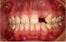 Female Receives Two Dental Implants