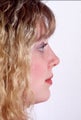 Rhinoplasty