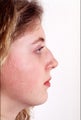 Rhinoplasty