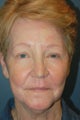 Chemical Peel