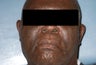Male Patient Treated with Sculptra